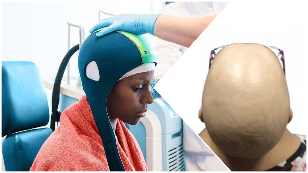 Chemotherapy Hair Loss: What to Expect