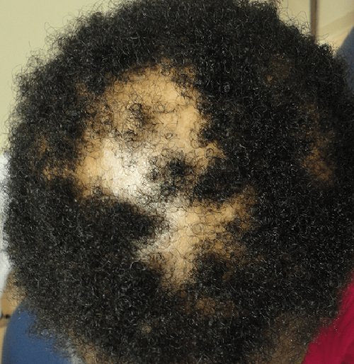 What Makes Alopecia Worse ?