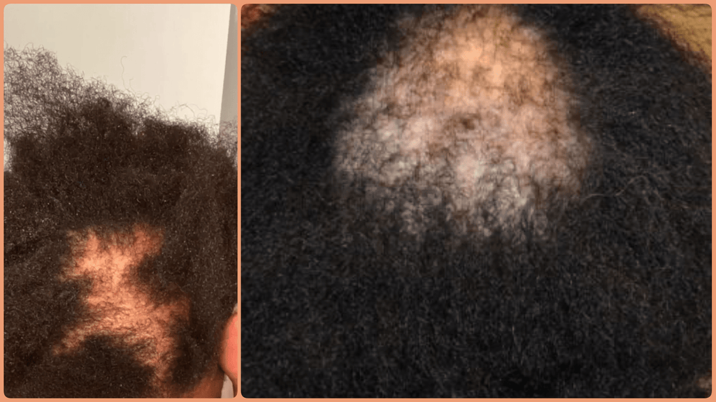 Hormonal Imbalance That Could Trigger Female pattern Hair Loss