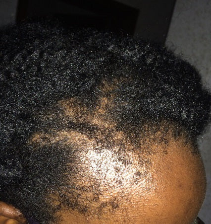 How to Grow Back, Protect, and Maintain Your Edges: A Complete Guide