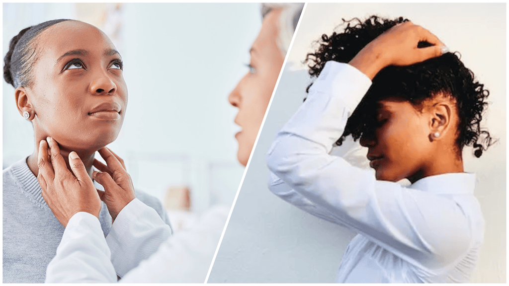 Thyroid Hair Loss