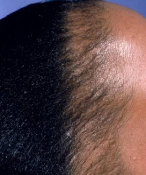 What Is The Best Way To Treat Alopecia